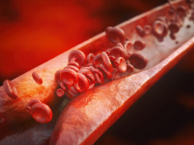 inflammation